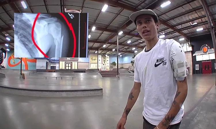 Trevor Colden, recuperado de su rotura de brazo